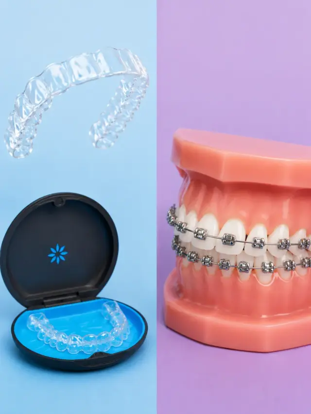 Invisalign vs Braces