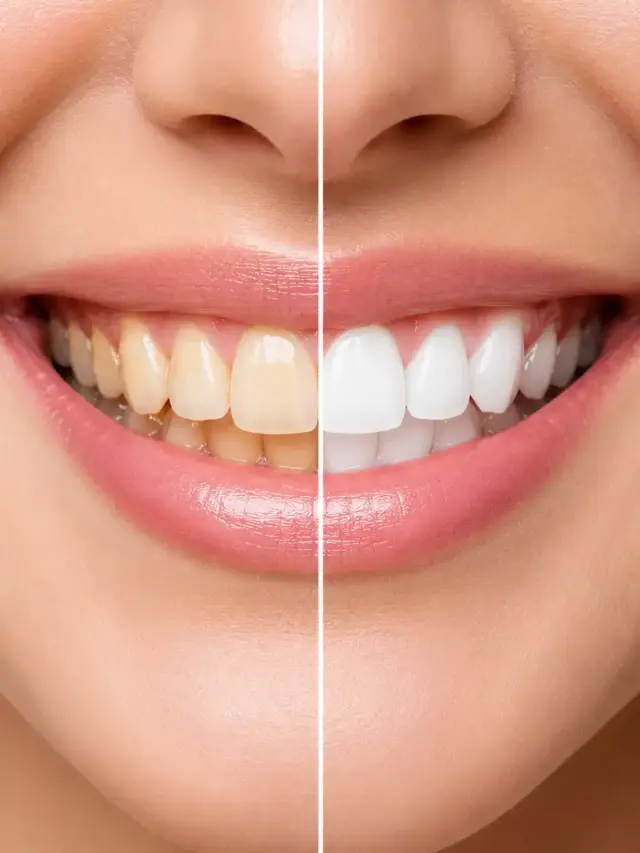 Teeth Whitening