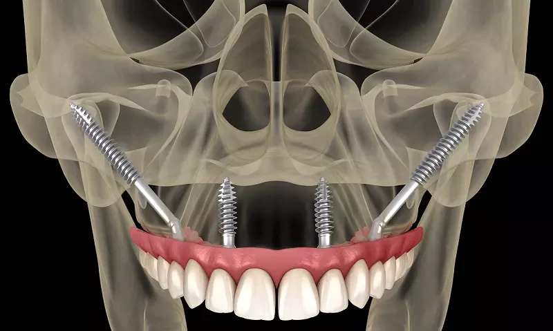 zygomatic-implants