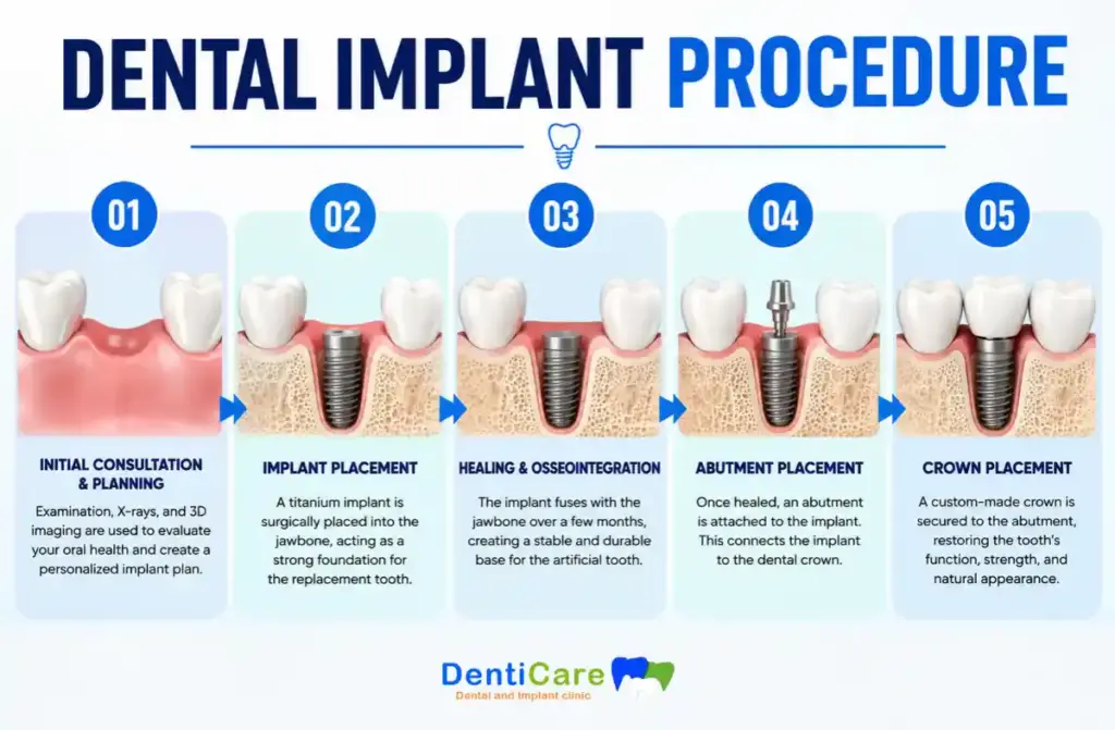 Dental Implants in Anna Nagar