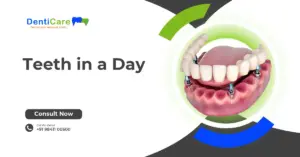 Teeth in a Day