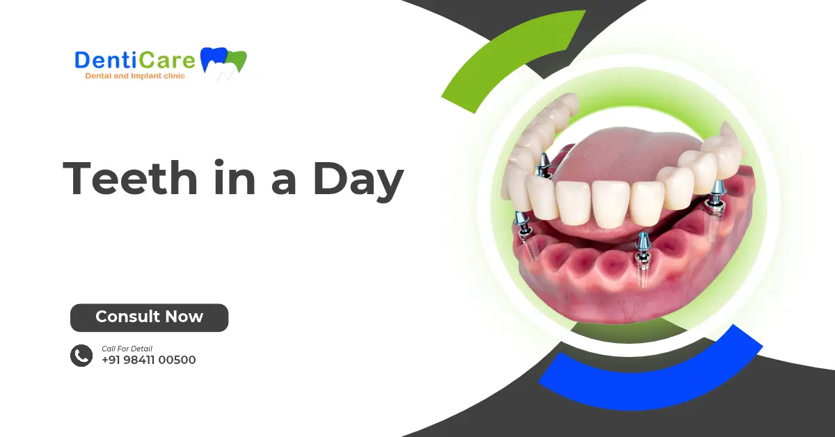 Teeth in a Day